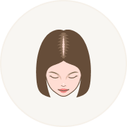 Female Hair Loss Pattern 2