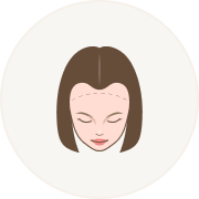 Female Hair Loss Pattern 3