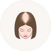 Female Hair Loss Pattern 4
