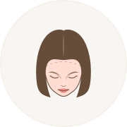 Female Hair Loss Pattern 6