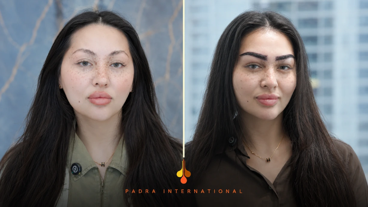 Eyebrow transplant before and after at Padra Medical Center Dubai