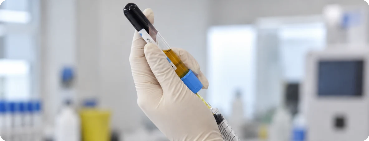 PRP Hair Treatment