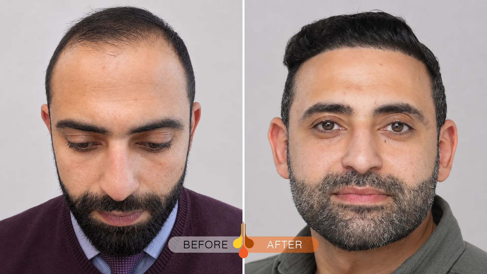 Hair transplant in Kuwait before and after one year at Padra Clinic