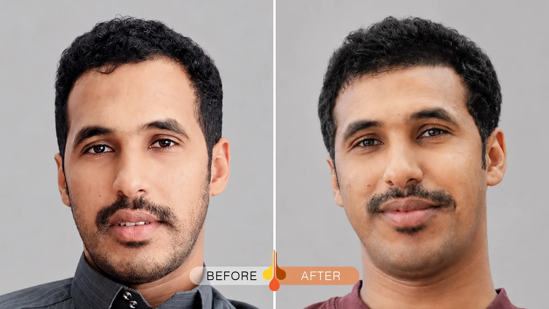 Padra hair transplant Kuwait before and after result with a natural hairline
