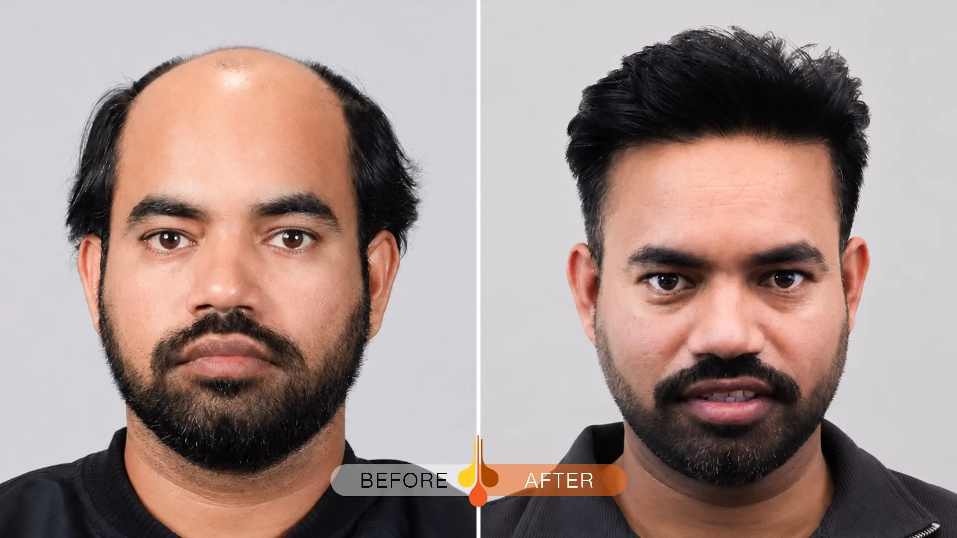 Hair transplant in Kuwait before and after showing improved hair density