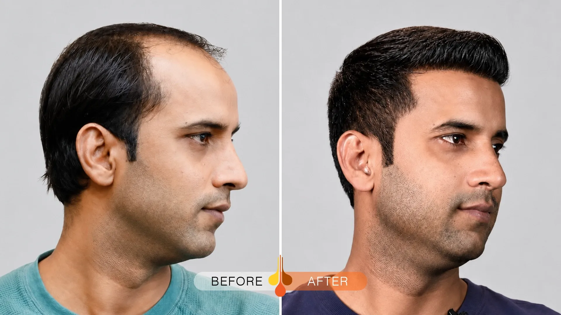 Before and after FUE hair transplant at Padra Kuwait