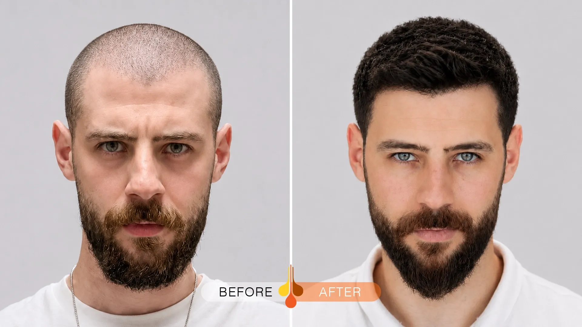 Natural hair transplant results in Kuwait before and after treatment