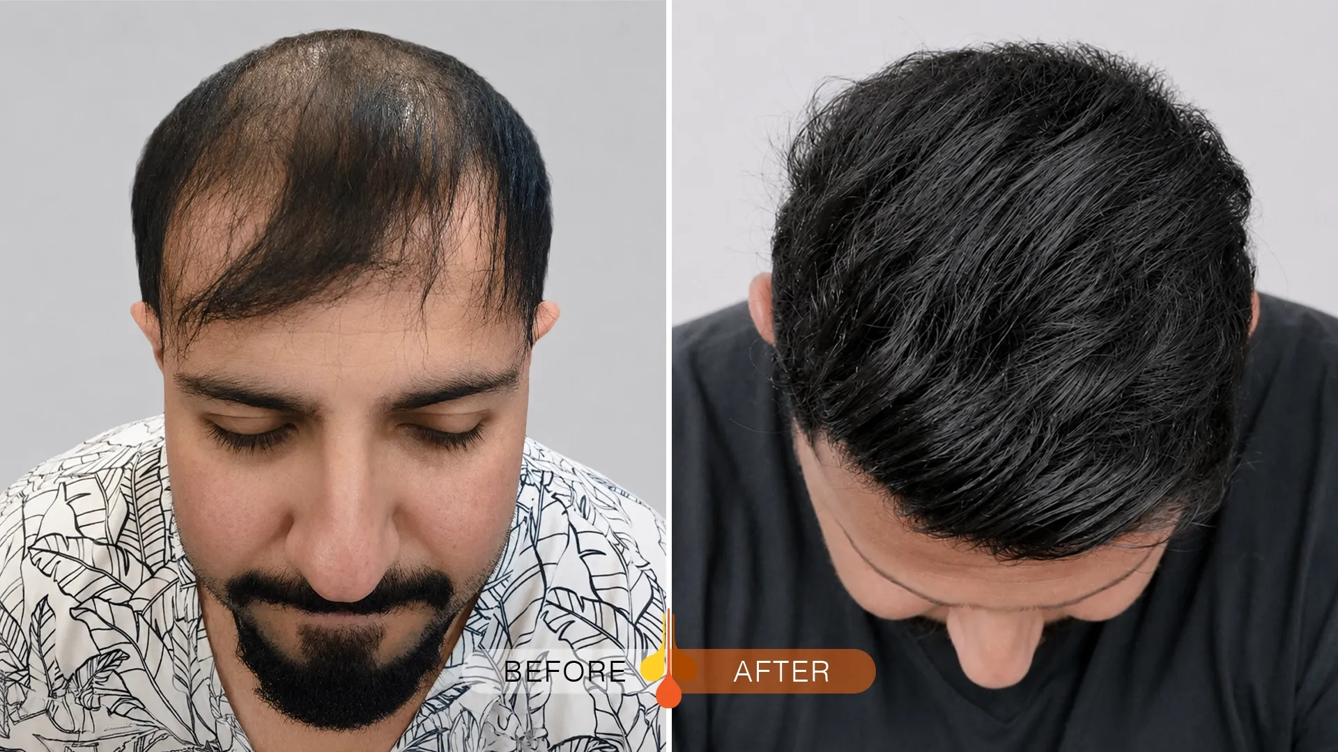 Before and after hair transplant in Kuwait at Padra Clinic