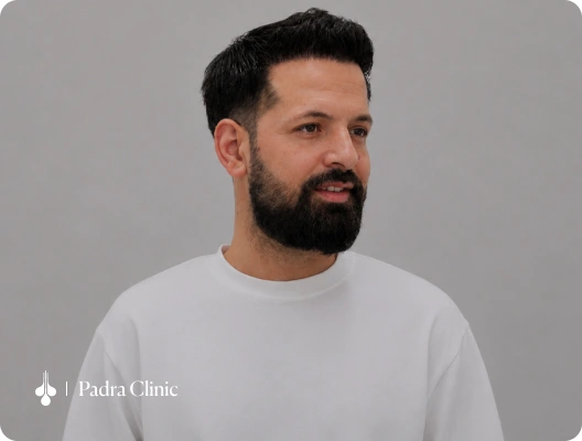 Male hair transplant patient featured in a Padra Clinic testimonial video