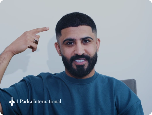 Man pointing to his restored frontal hairline after a hair transplant in Kuwait