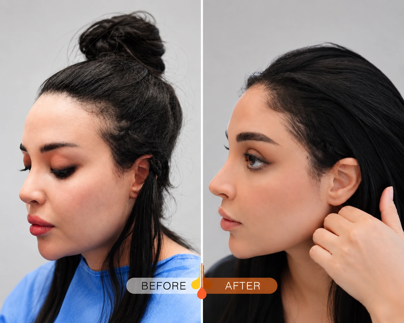 Female hairline transplant before and after results at Padra Clinic