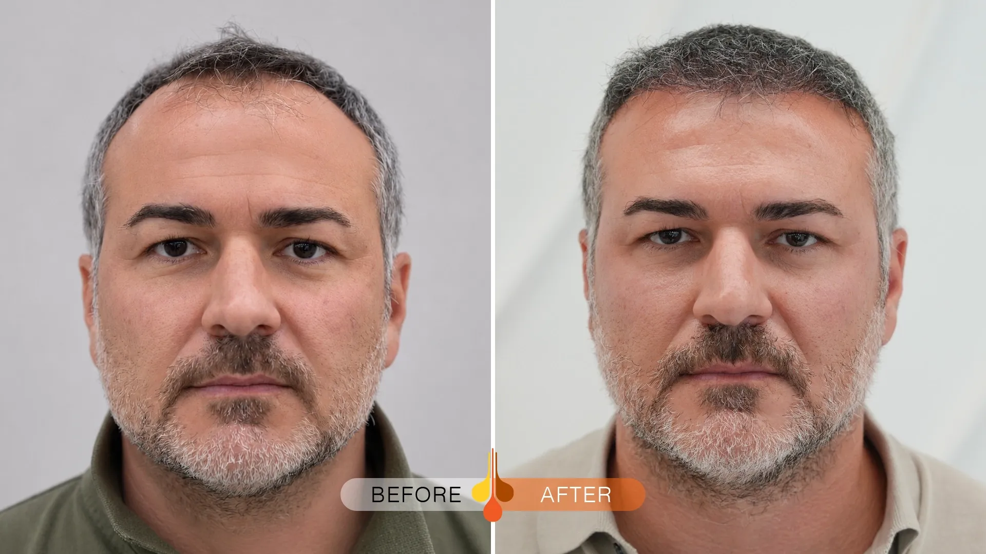 Before and after hair transplant in Dubai showing natural frontal hairline results
