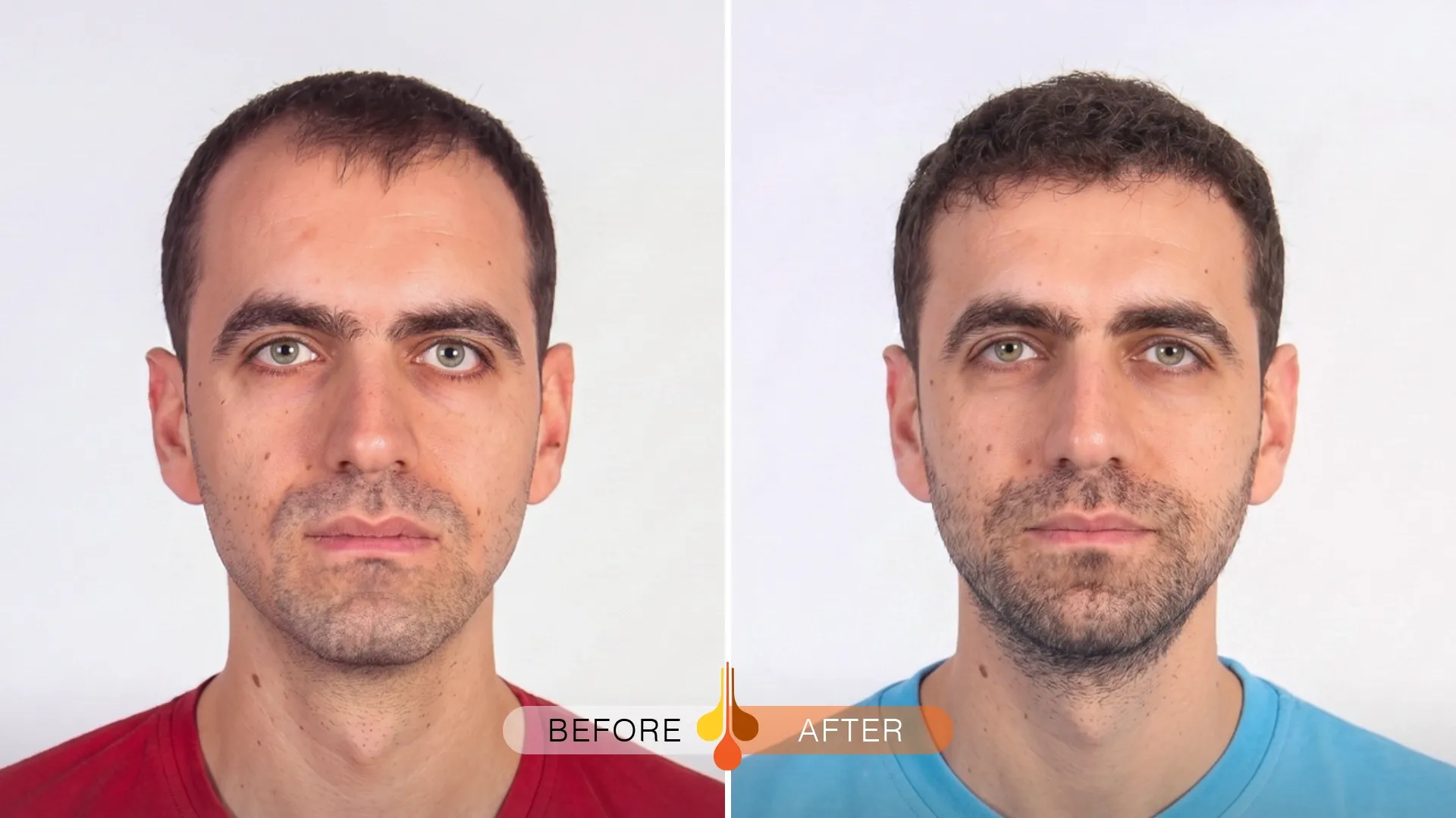 Padra hair transplant Dubai before and after results for receding temples