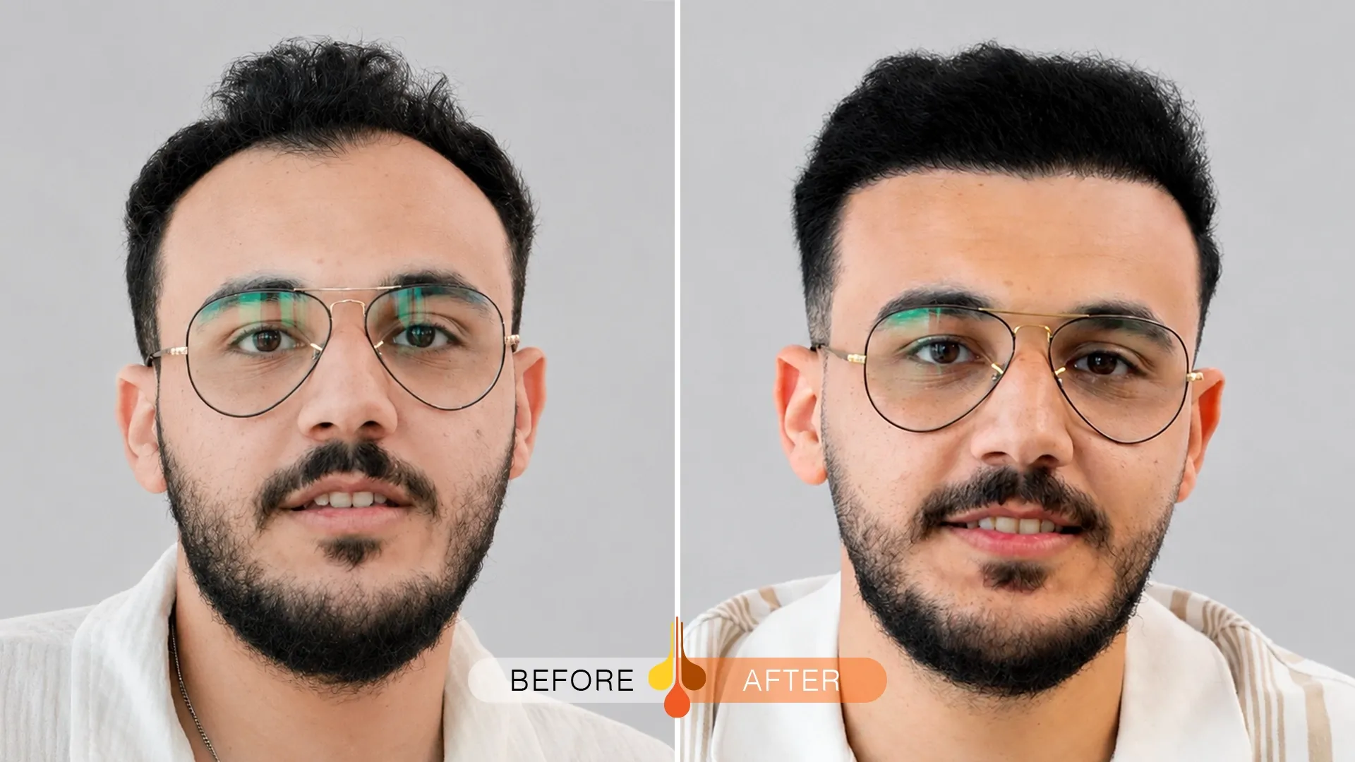 Before and after hair transplant at Padra Clinic Dubai showing crown and vertex restoration