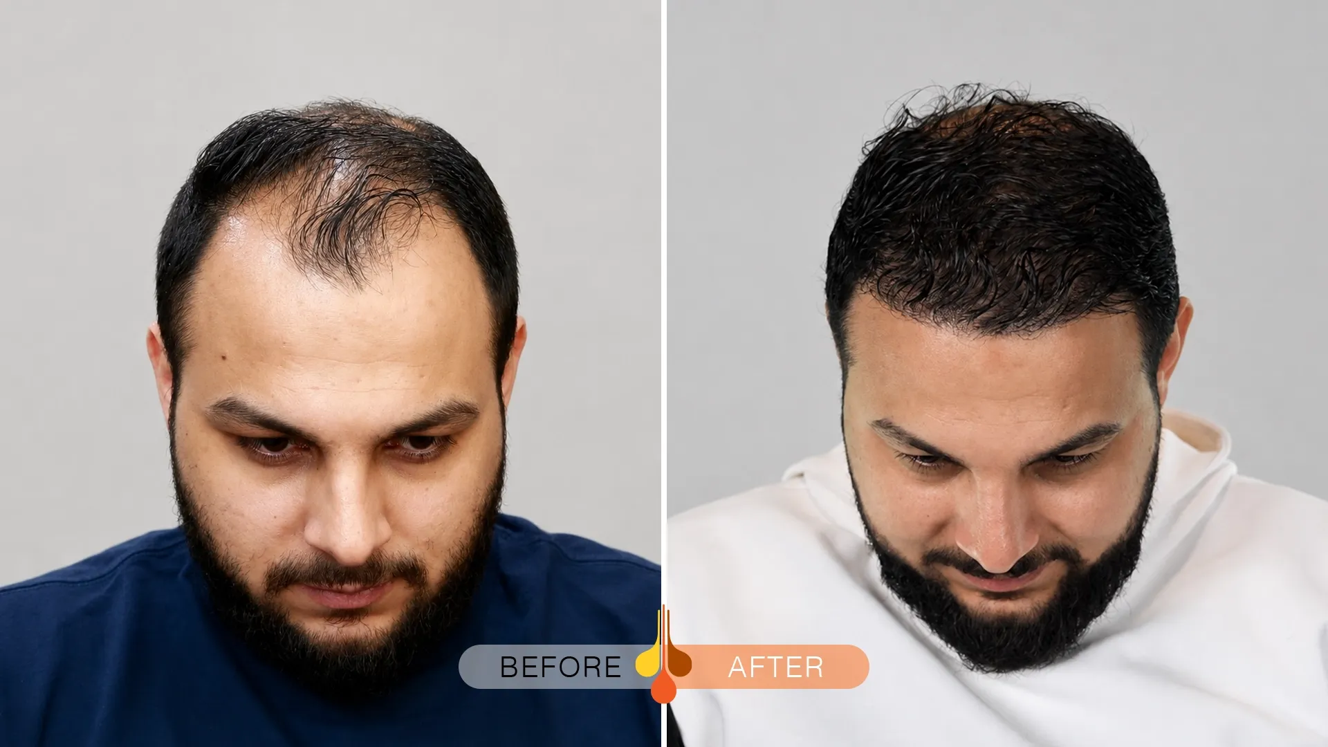 Hair transplant in Saudi Arabia after one year showing natural-looking hair density and coverage
