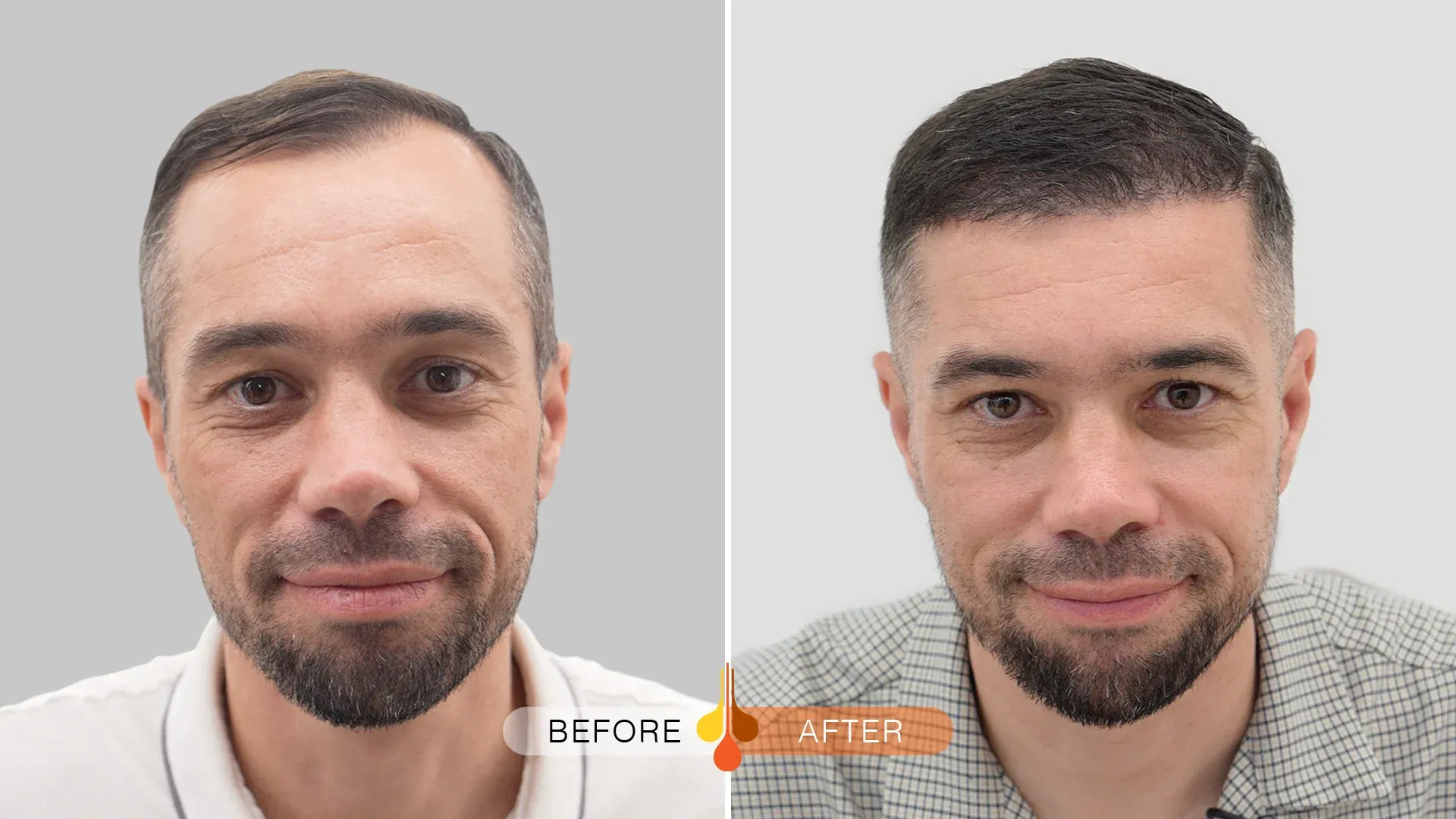 Before and after FUE hair transplant in Riyadh showing fuller hairline and temple restoration