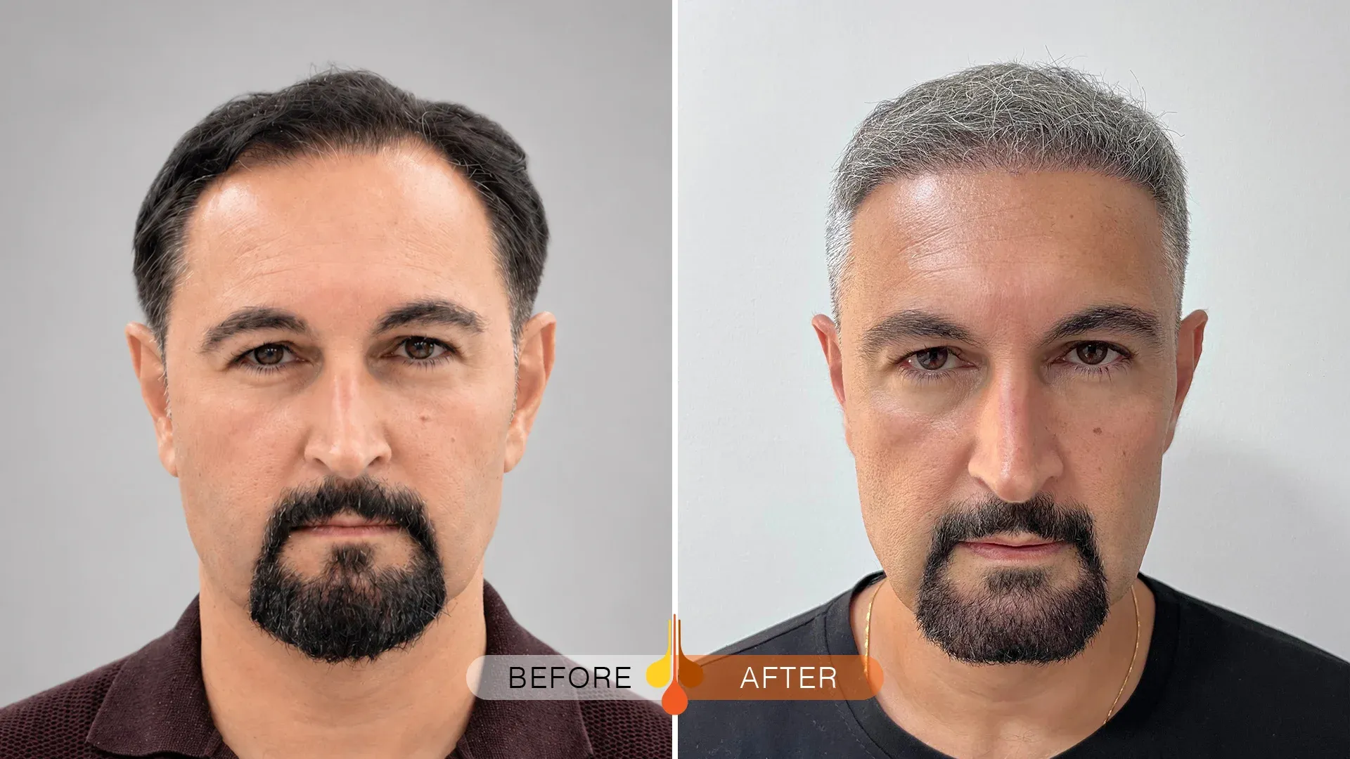 Hair transplant results in Riyadh after 6 months showing new growth across the frontal scalp