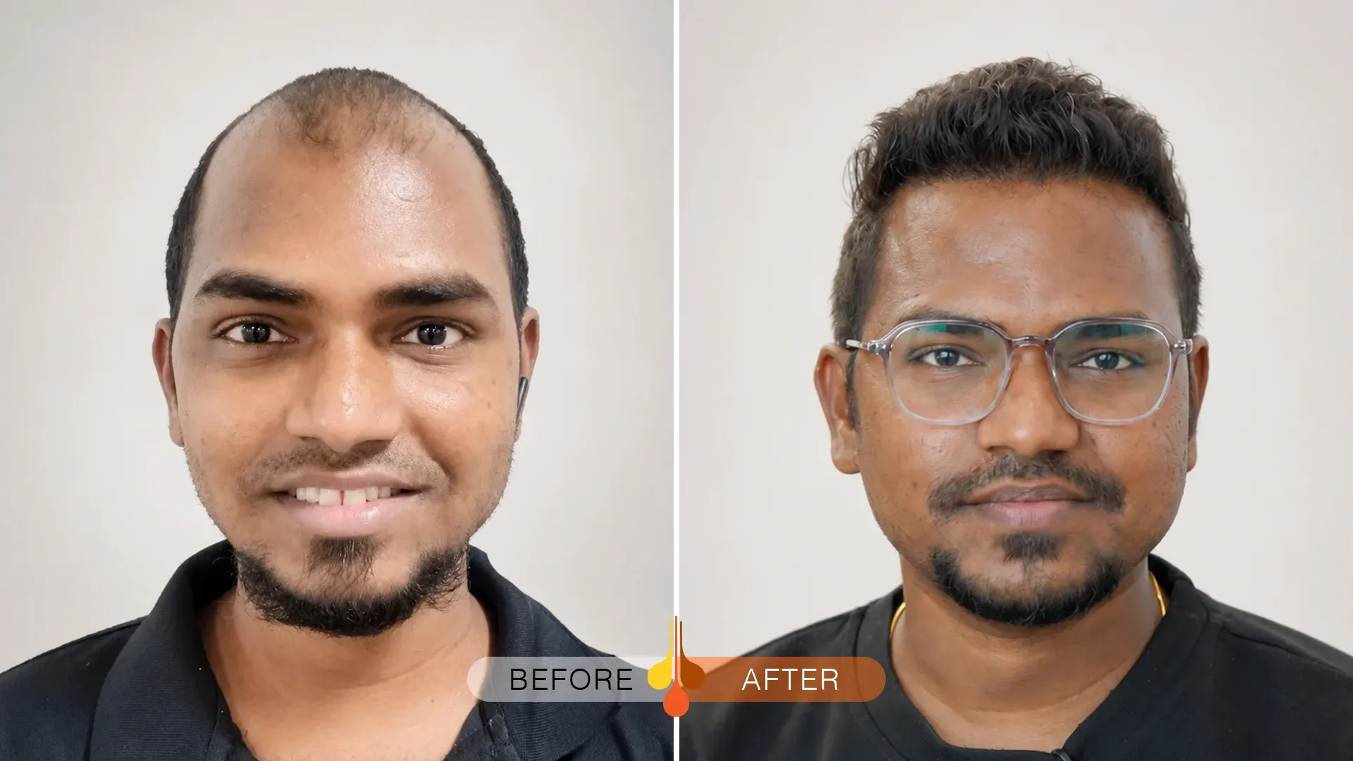 FUE hair transplant in Saudi Arabia before and after showing increased crown hair density