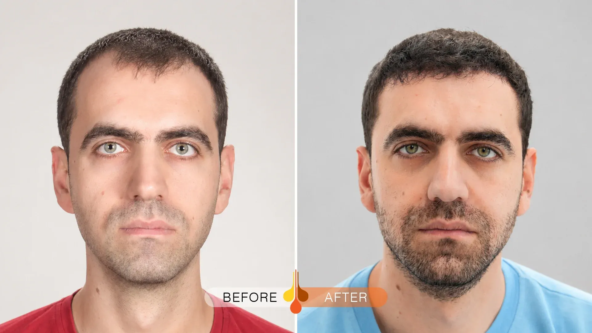 Hair transplant in Riyadh before and after results with improved density in the front and temples