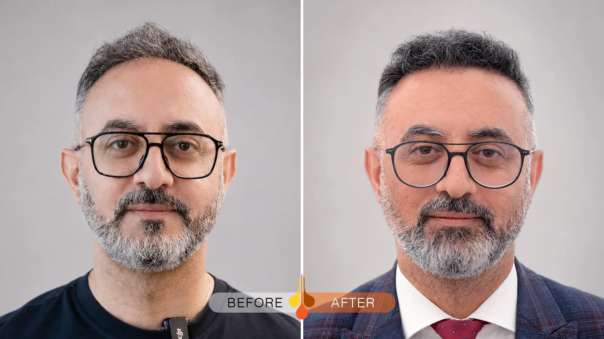 Before and after hair transplant in Riyadh, Saudi Arabia showing a restored frontal hairline