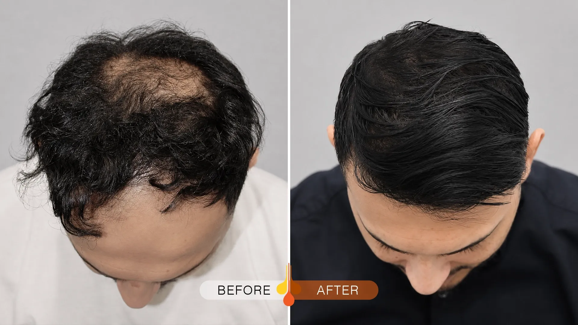 before after hair transplant in qatar