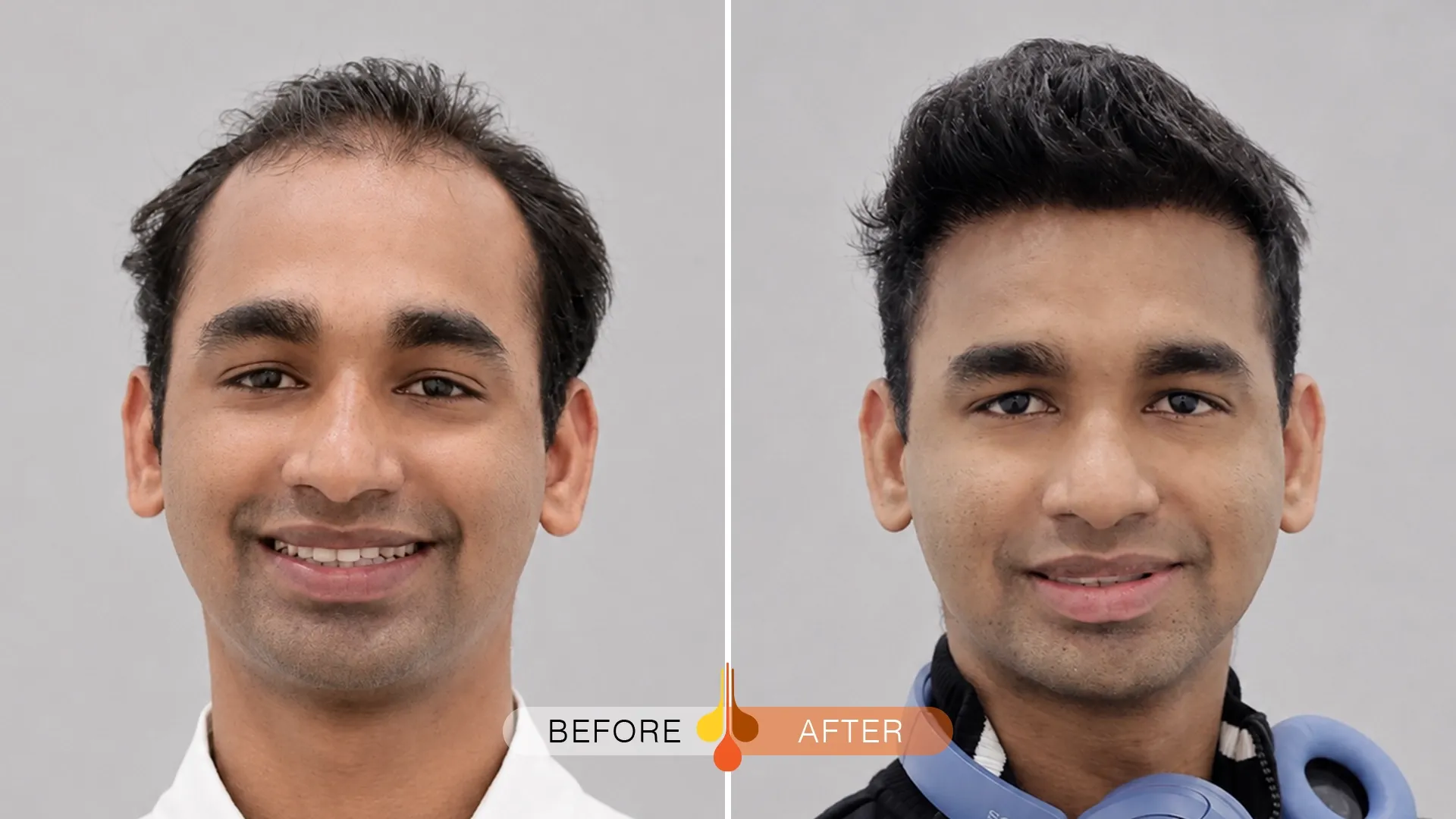 before after hair transplant doha