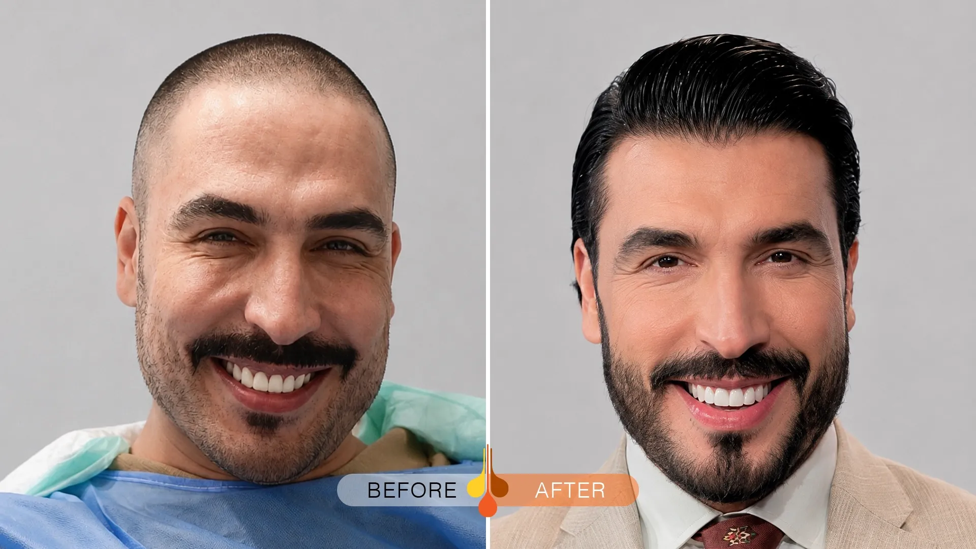 Before and after hair transplant result in Doha, Qatar