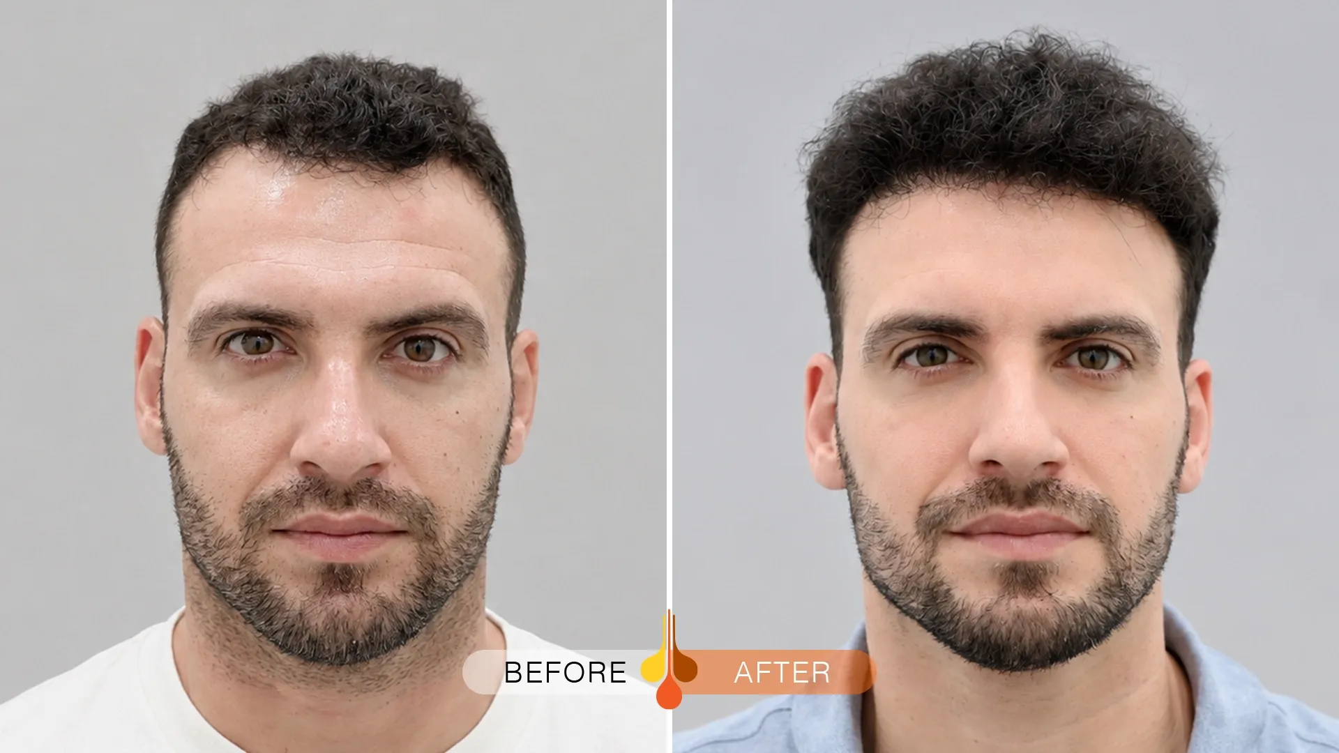 Hair transplant before and after at Padra Clinic Doha