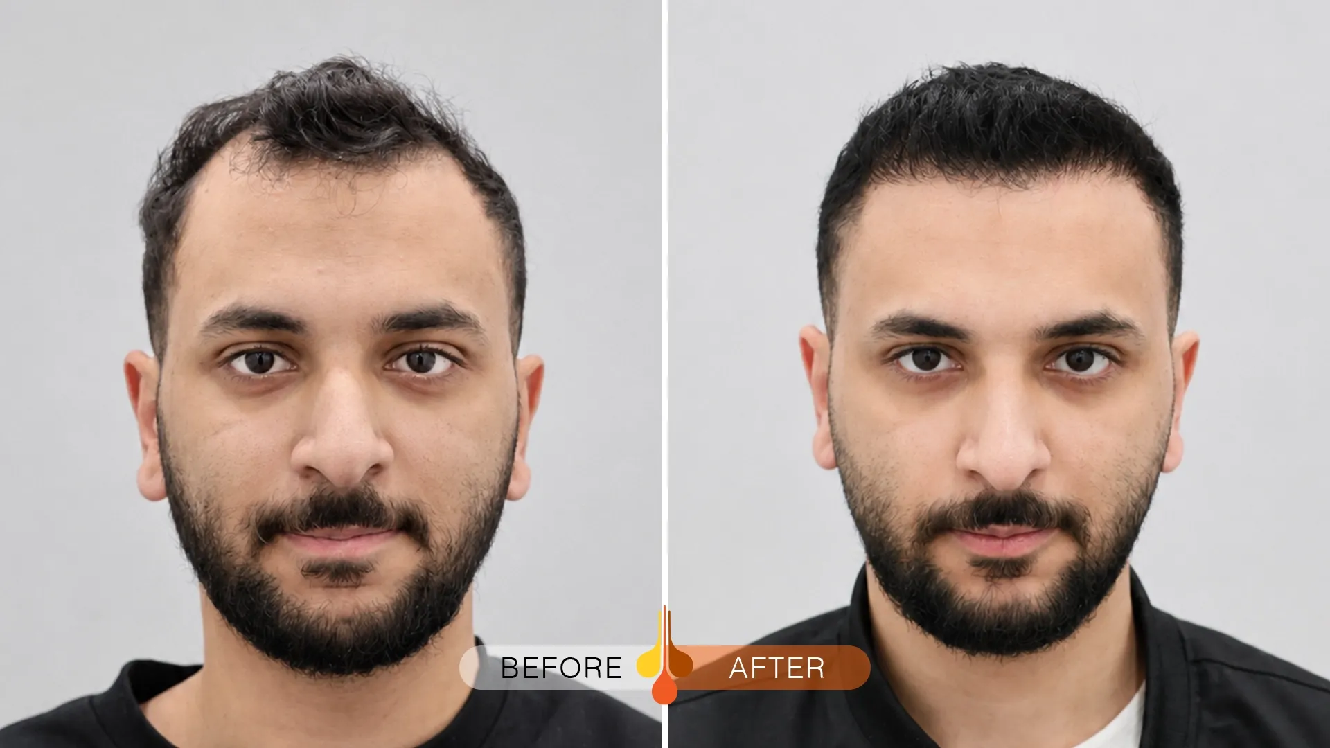 Natural hair transplant result before and after in Doha