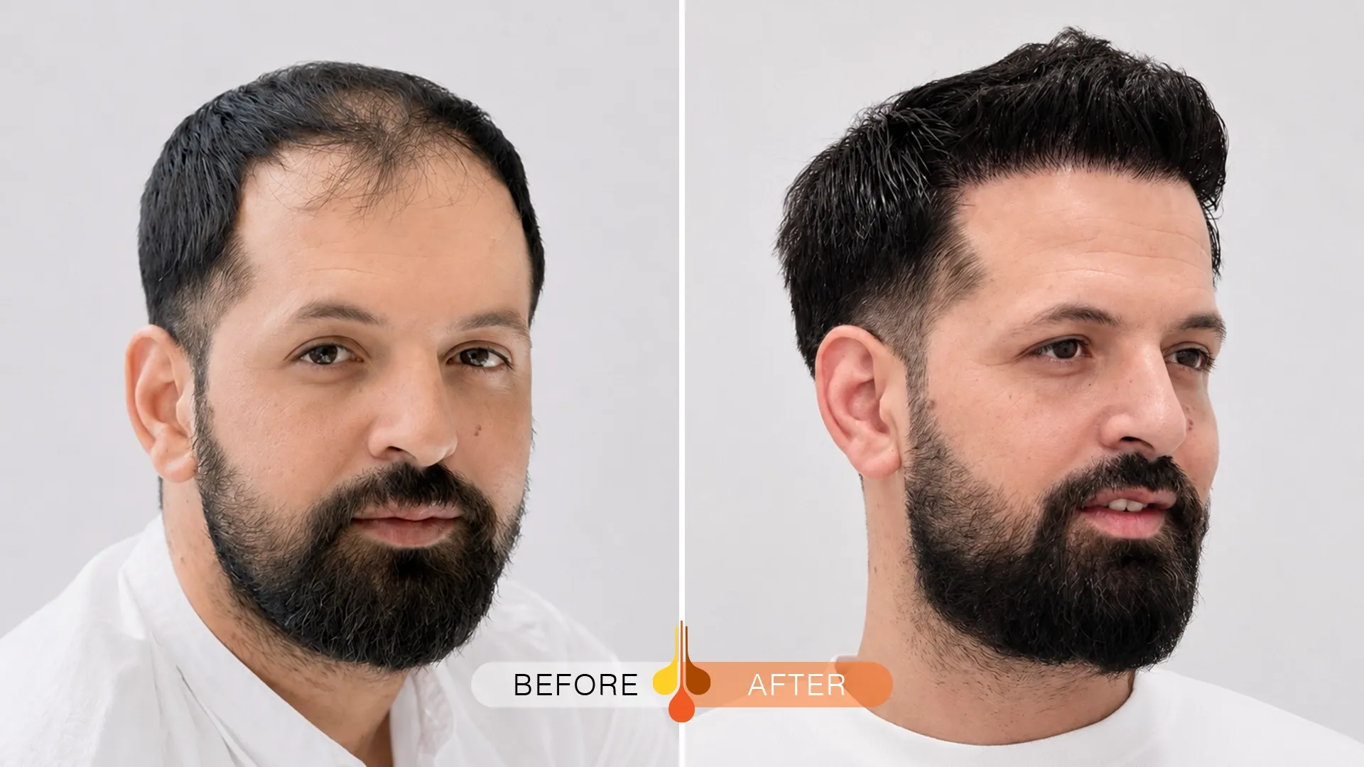 Hair transplant transformation at Padra Clinic in Qatar