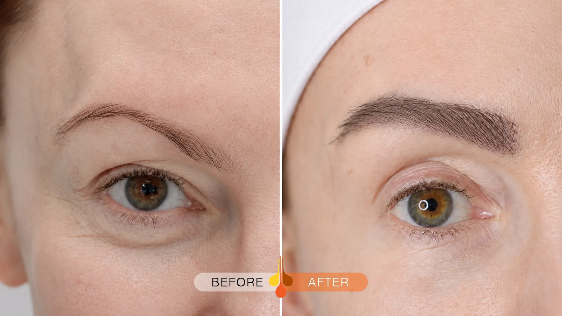 eyebrow-transplant-kuwait-01
