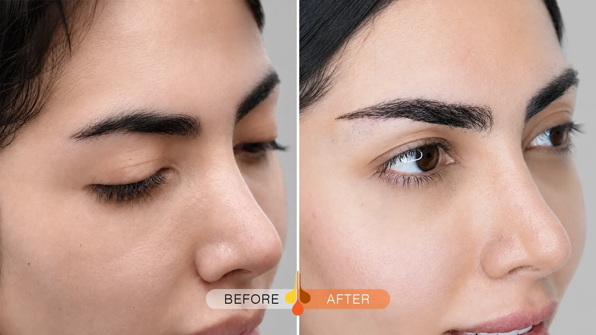 eyebrow-transplant-kuwait-02