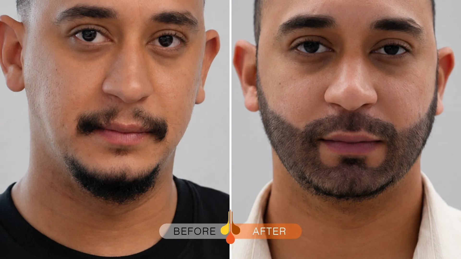 Beard-Moustache-Transplant-Dubai-01