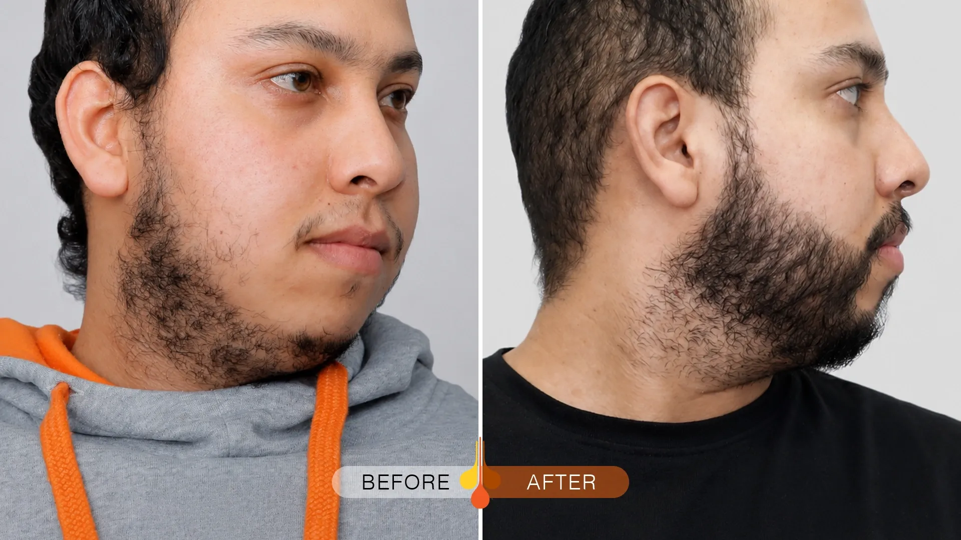 Beard-Moustache-Transplant-Dubai-02