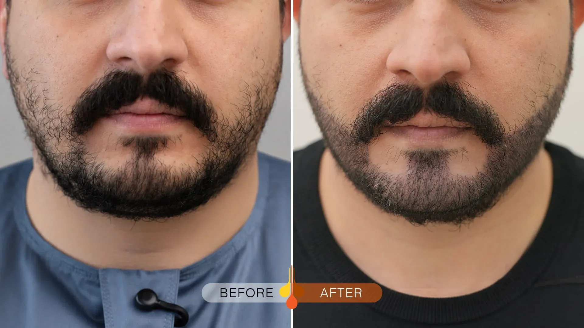 Beard-Moustache-Transplant-Dubai-03