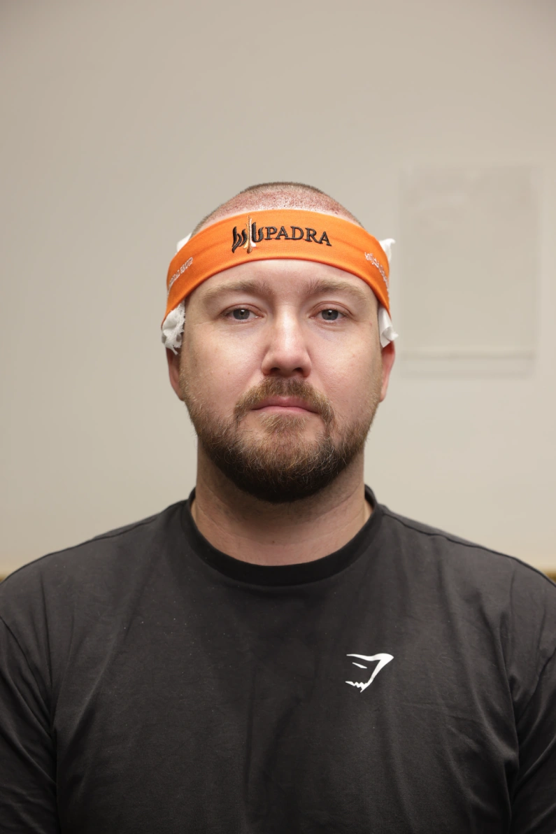 Male patient immediately after a hair transplant treatment at Padra Clinic