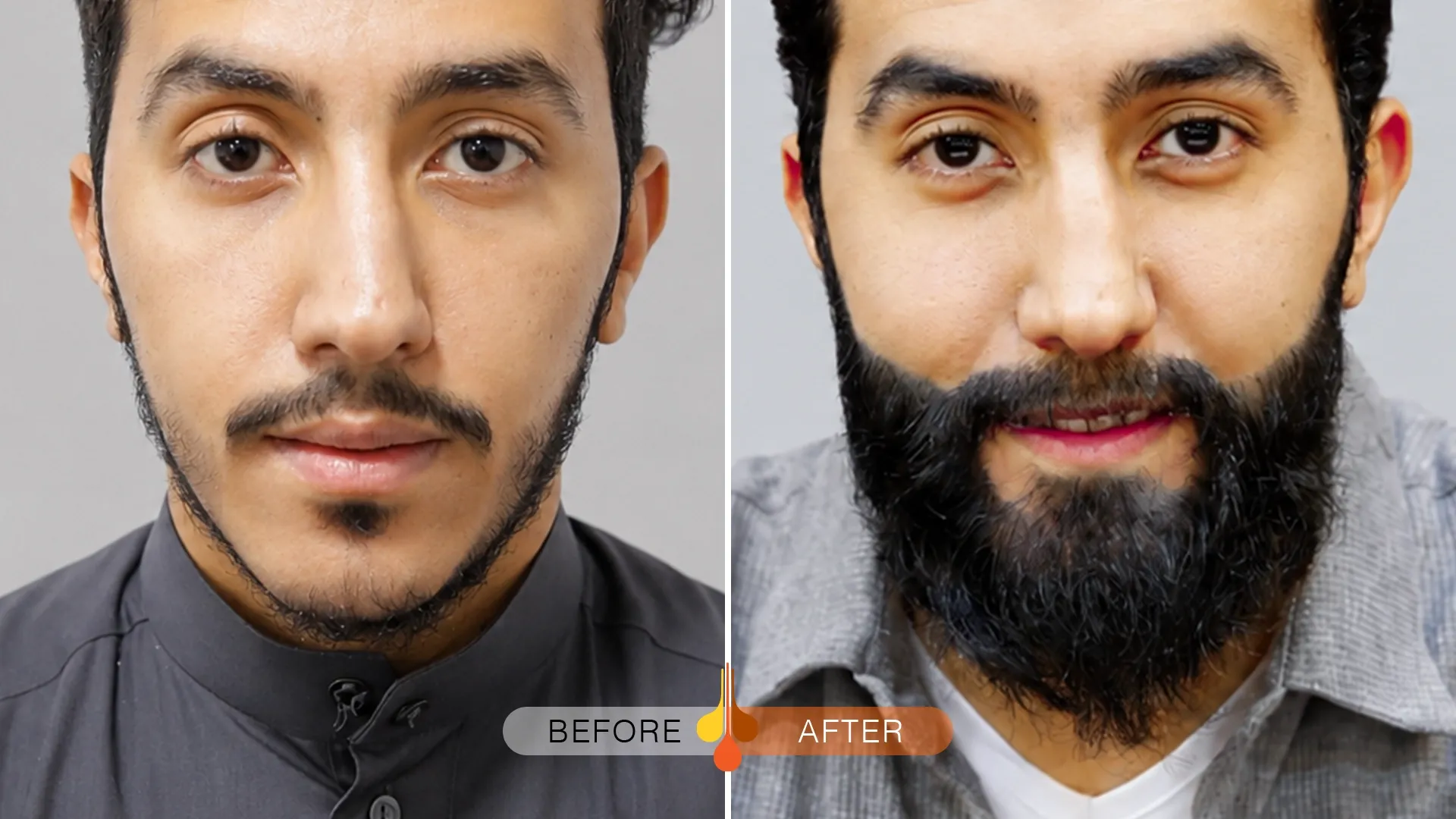 beard-moustache-transplant-kuwait-01