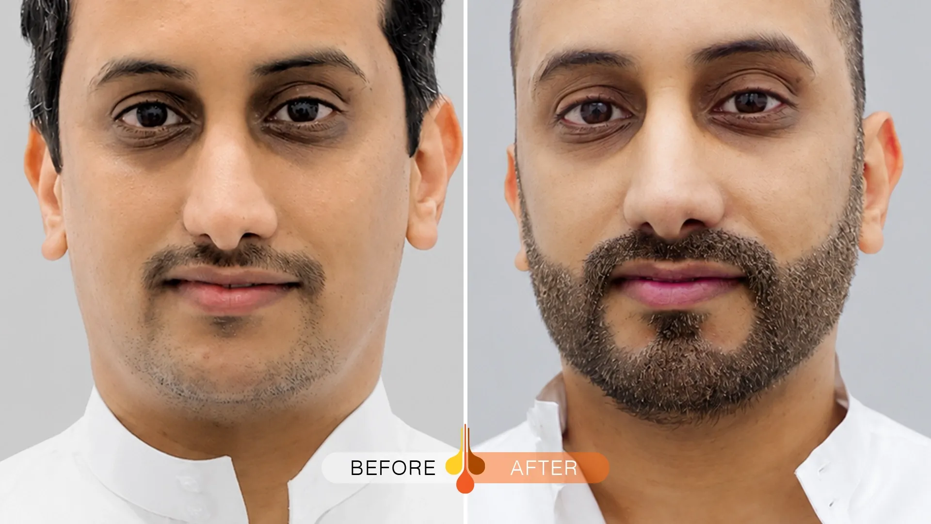 beard-moustache-transplant-kuwait-02