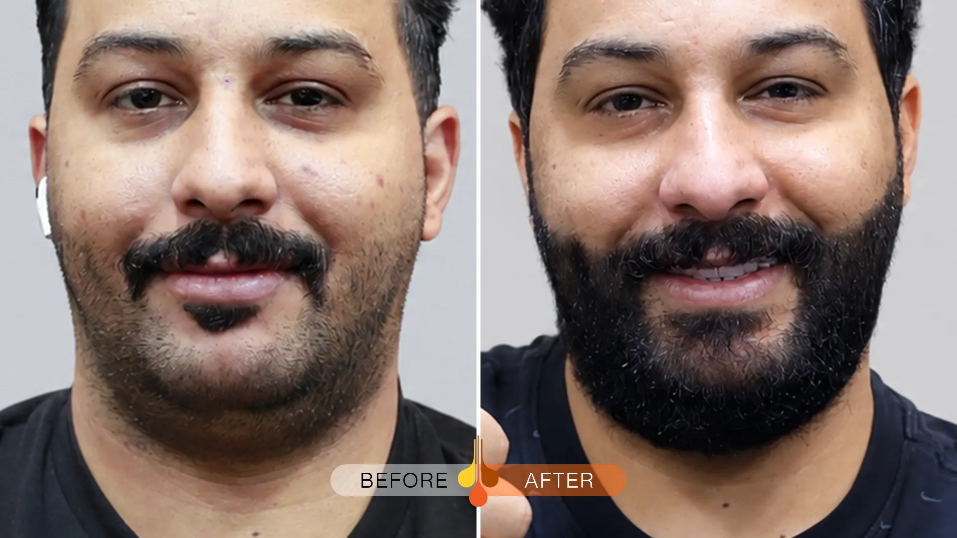 beard-moustache-transplant-kuwait-03