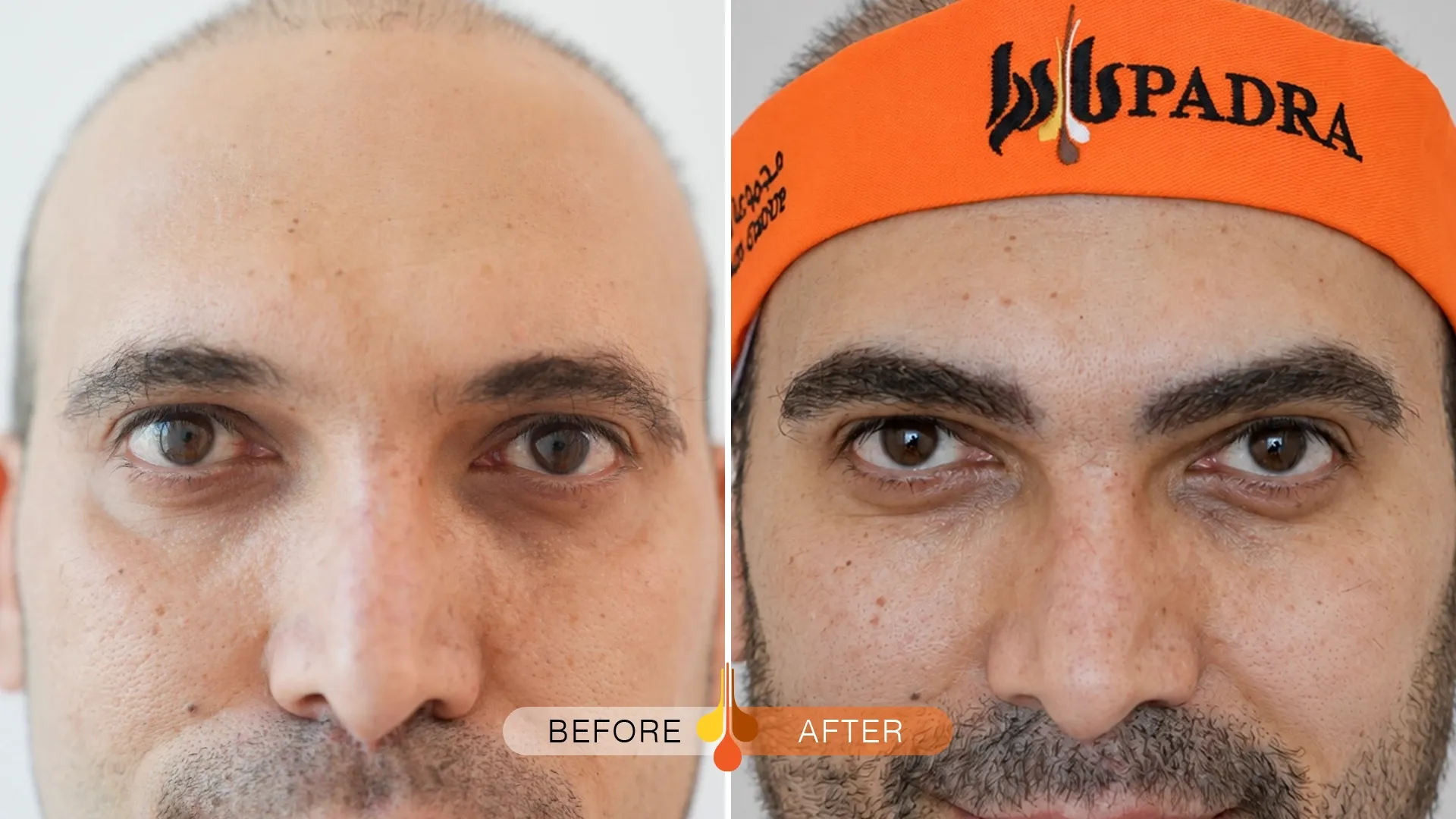 eyebrow-transplant-dubai-03