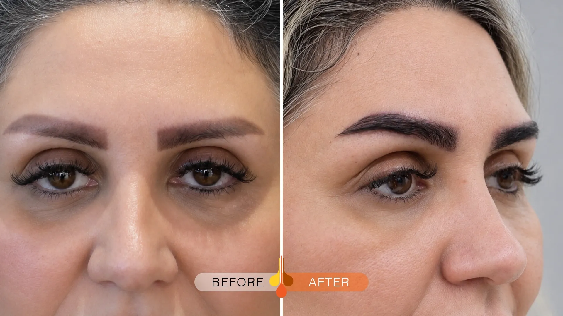 eyebrow-transplant-dubai-04