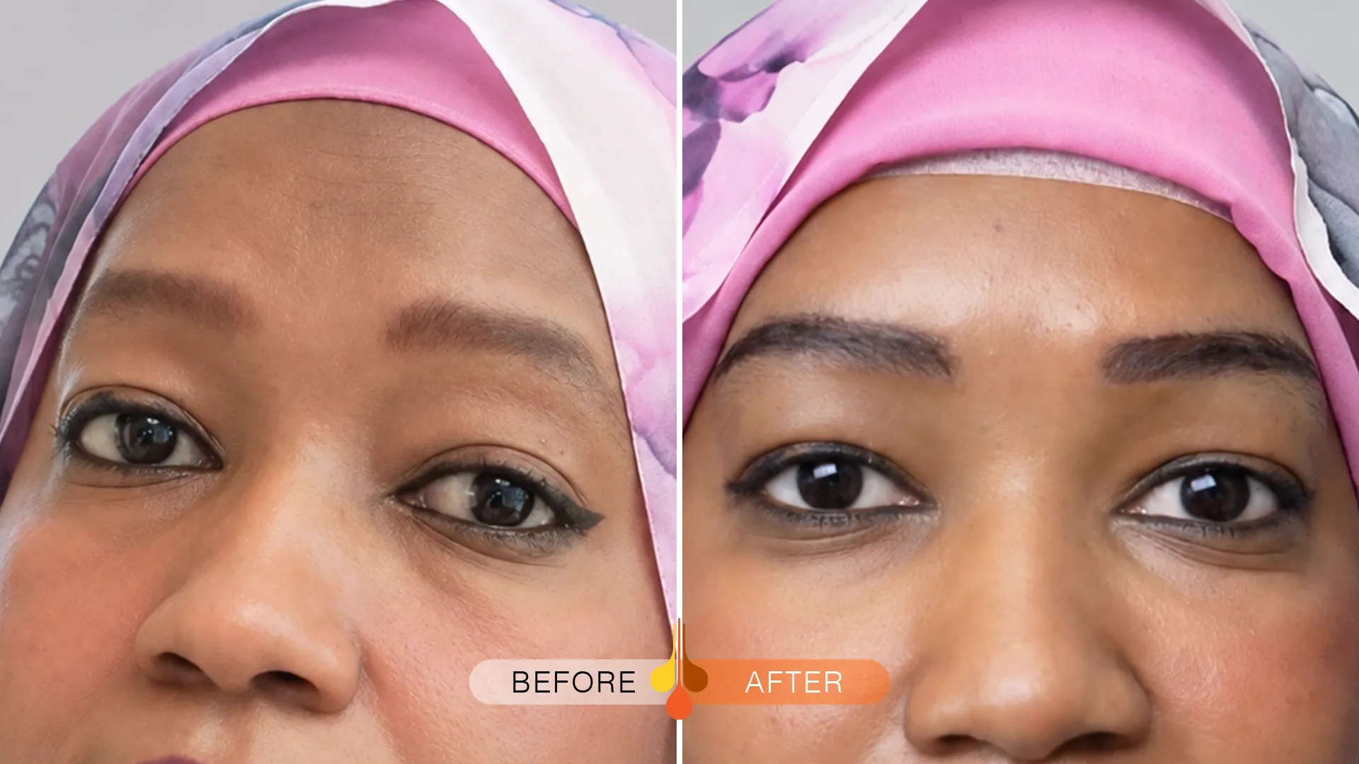 eyebrow-transplant-dubai-05