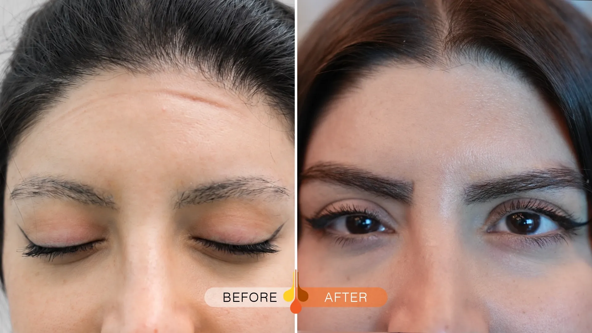 eyebrow-transplant-dubai-06