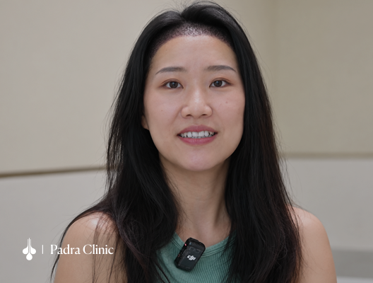 Hairline transplant patient at Padra Clinic Dubai