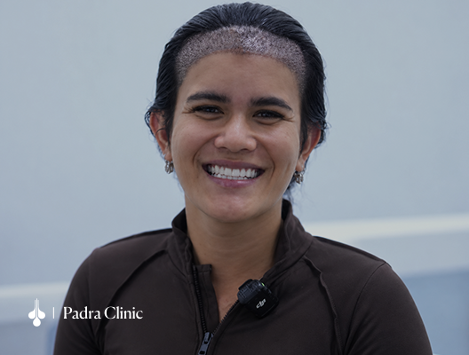 Female hair transplant at Padra Clinic Dubai
