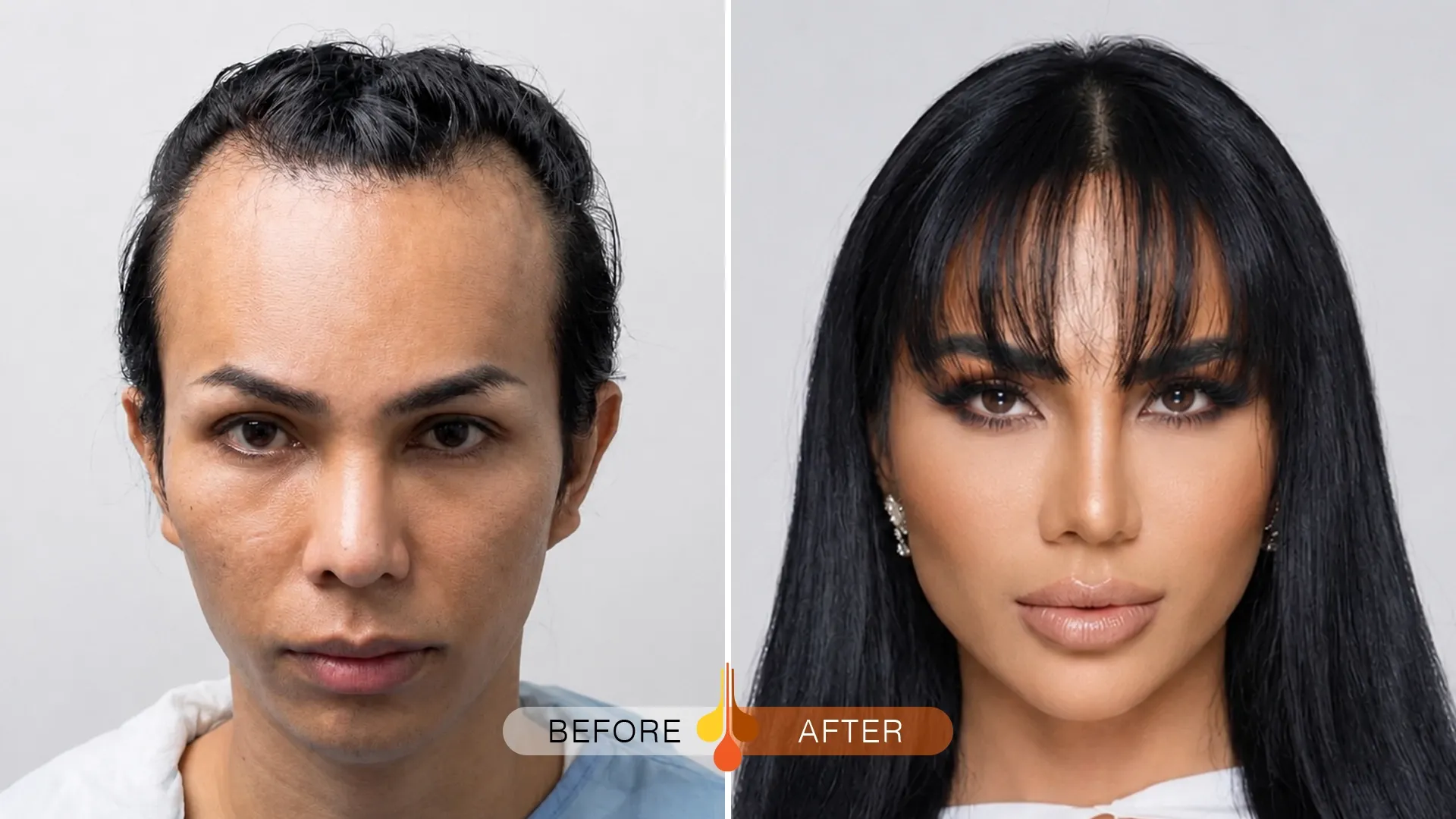 womens-hair-transplant-01