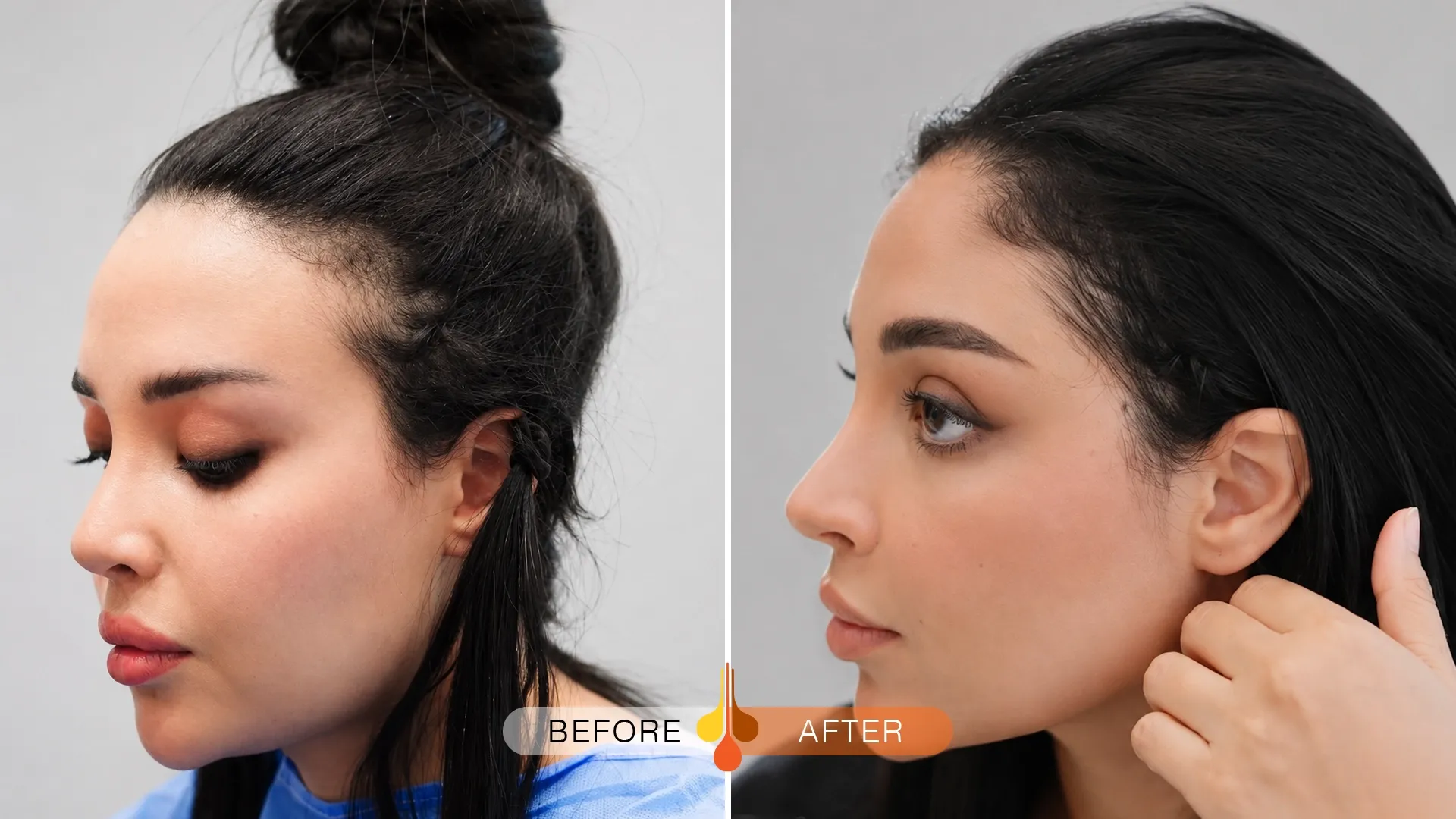 womens-hair-transplant-02