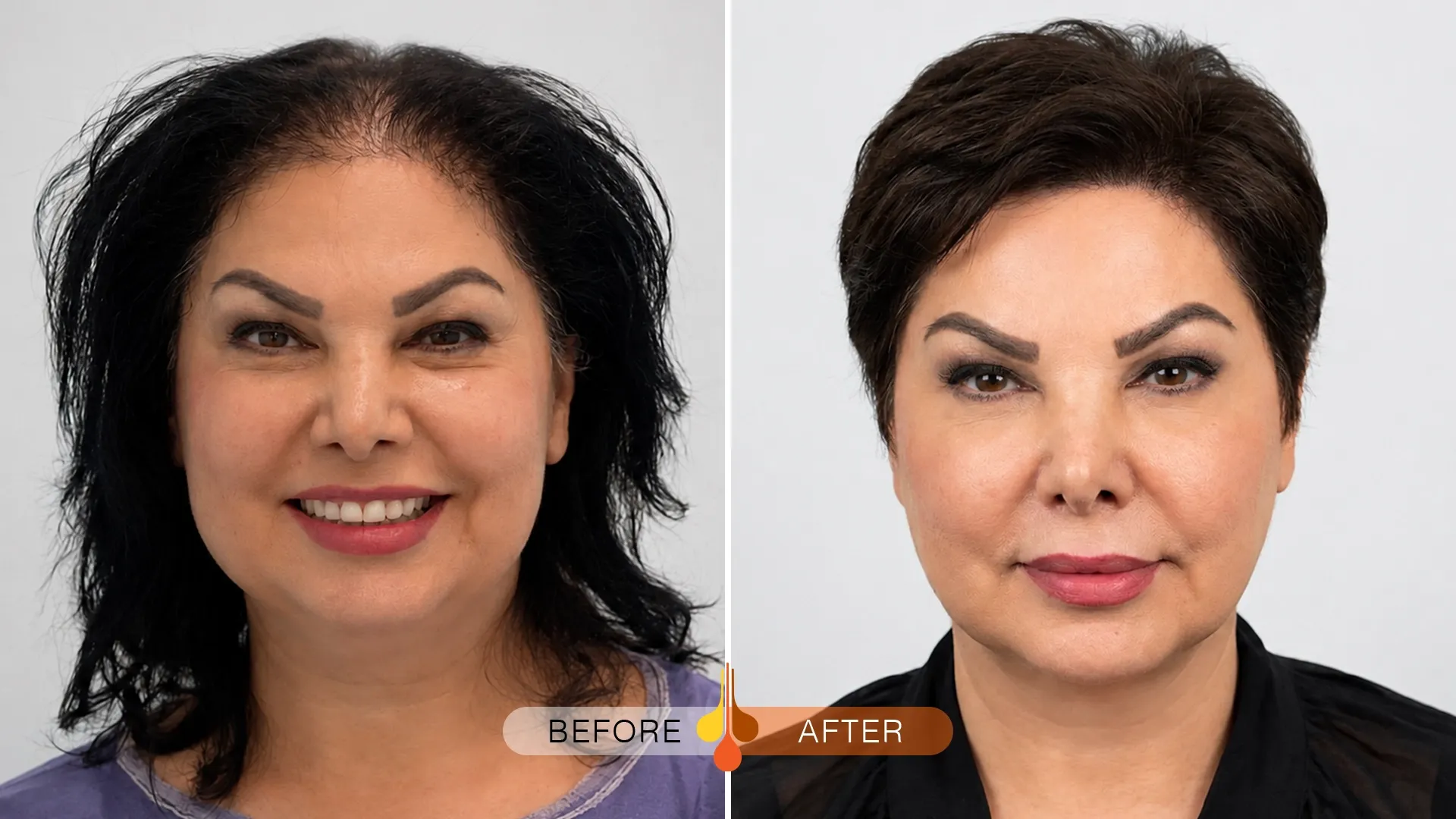 womens-hair-transplant-03