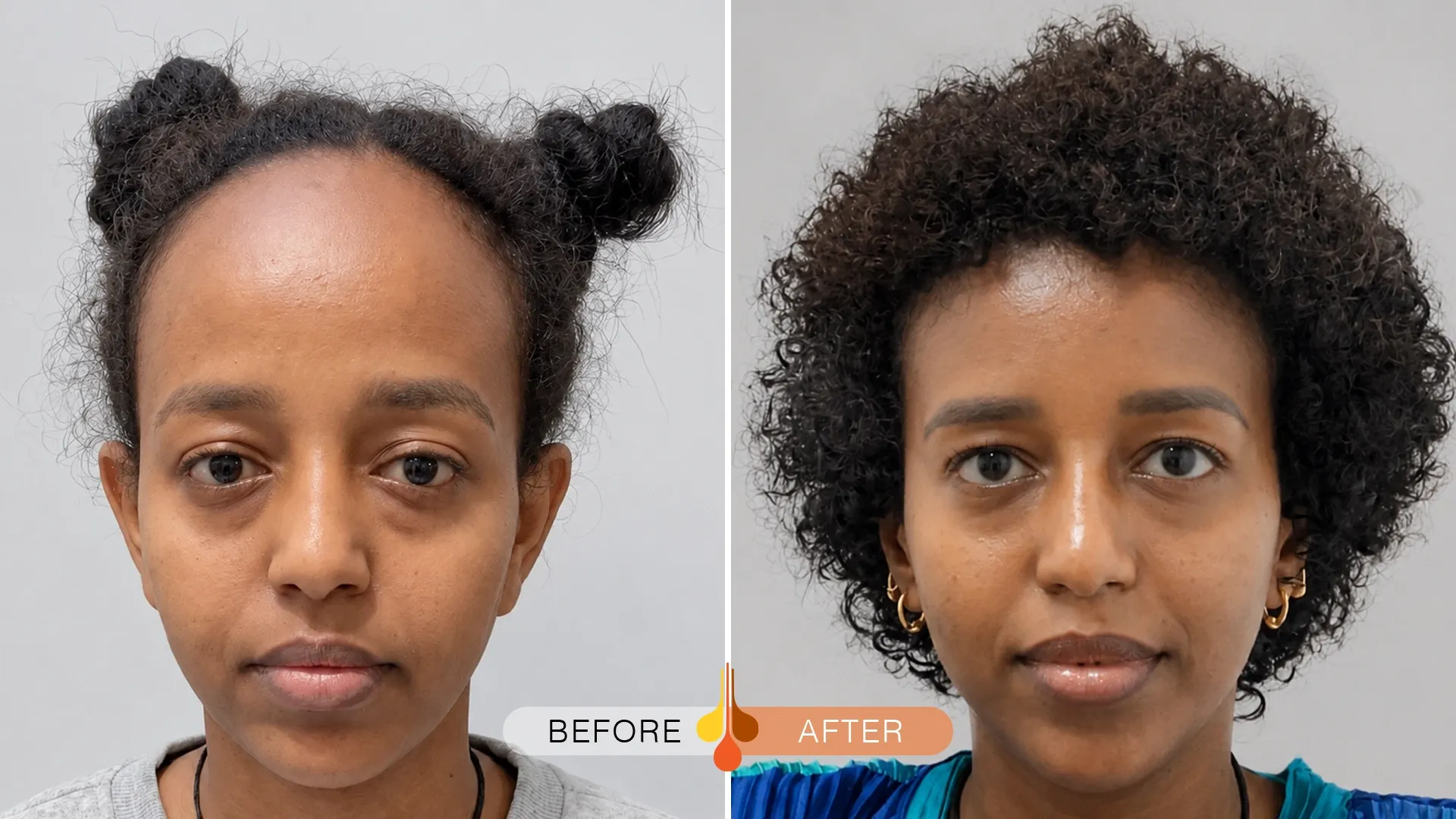 womens-hair-transplant-dubai