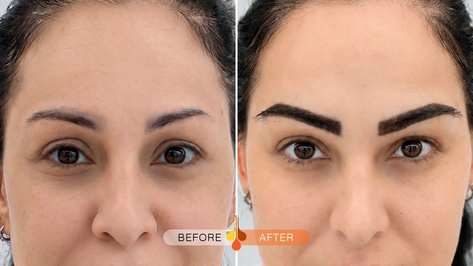 eyebrow-transplant-ksa-01
